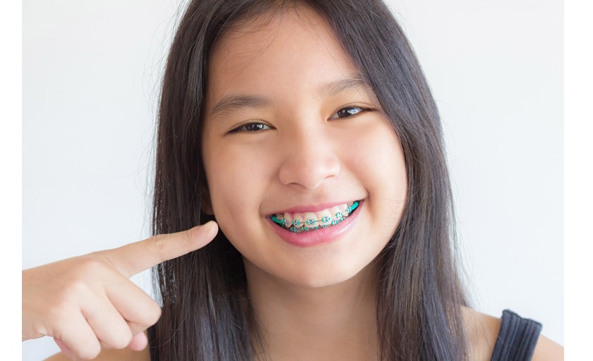 Niềng răng mắc cài kim loại
