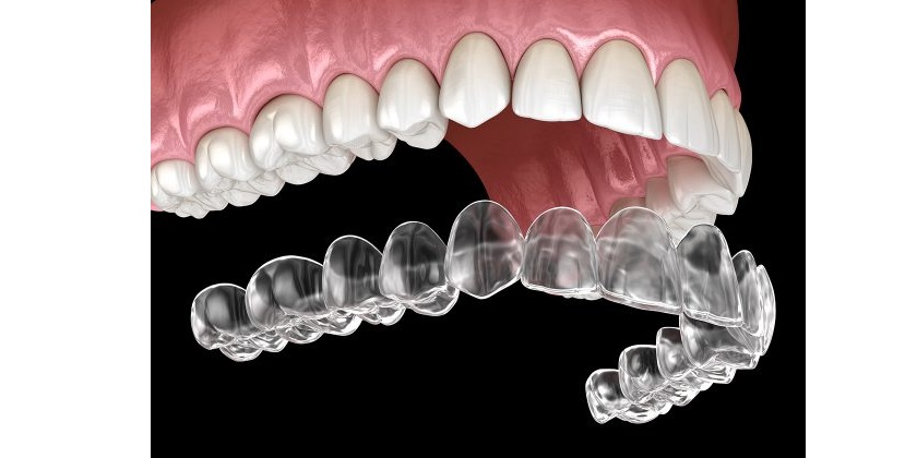 Niềng răng hô với khay niềng trong suốt hiện đại