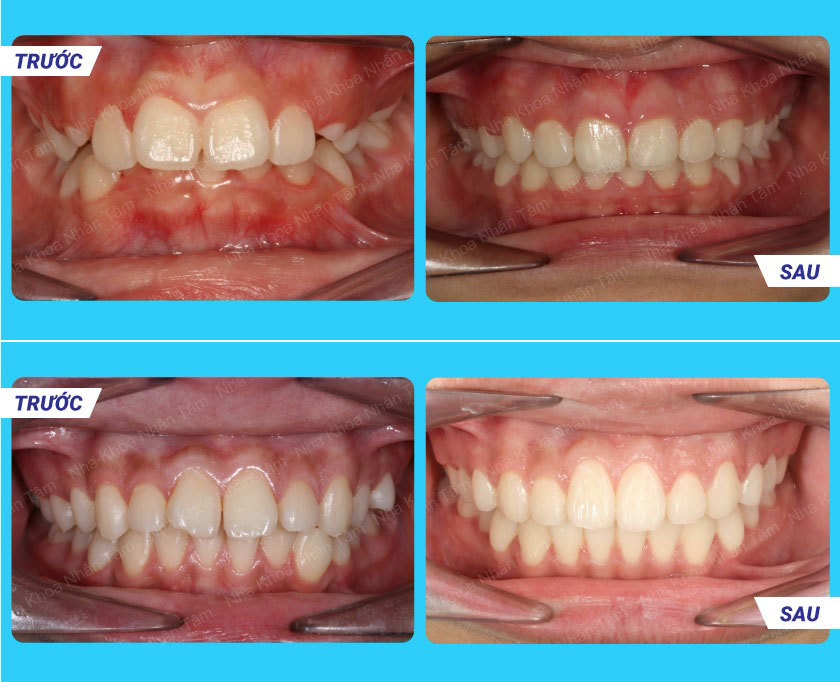 Khách hàng niềng răng thành công tại Nha khoa Nhân Tâm