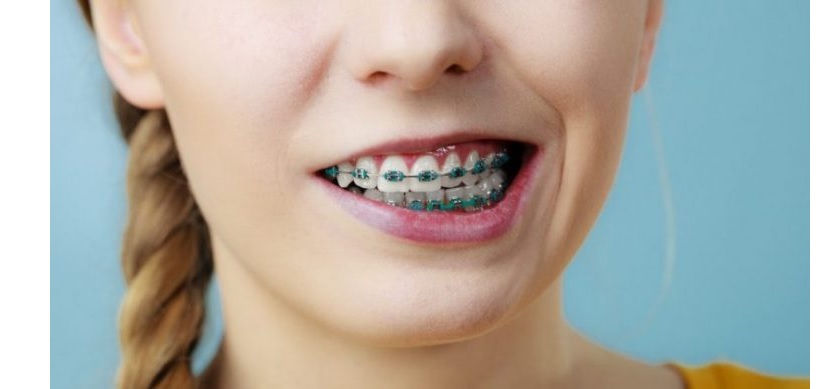 Răng bị rụng sớm là nguy cơ hoàn toàn có thể xảy ra nếu răng bị lúc lay khi niềng