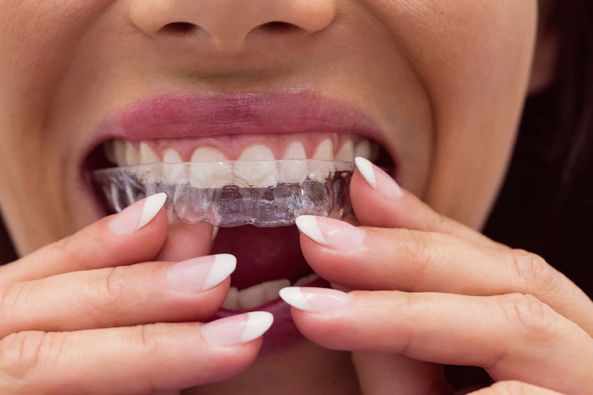 Niềng răng Invisalign mang lại sự thoải mái, tiện lợi
