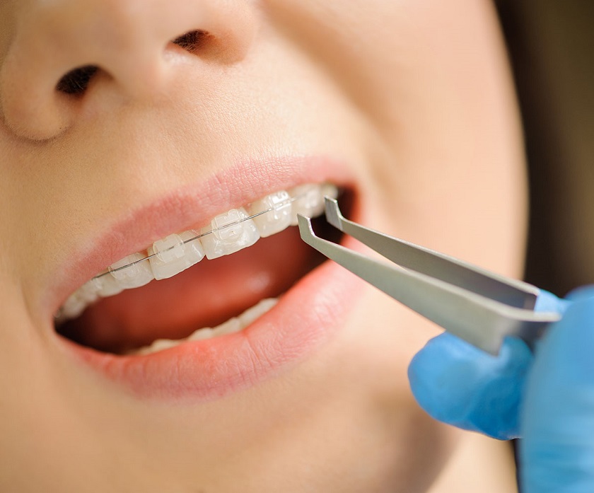 Niềng răng mắc cài sứ sẽ khắc phục các tình trạng răng hô, móm, khấp khểnh,...