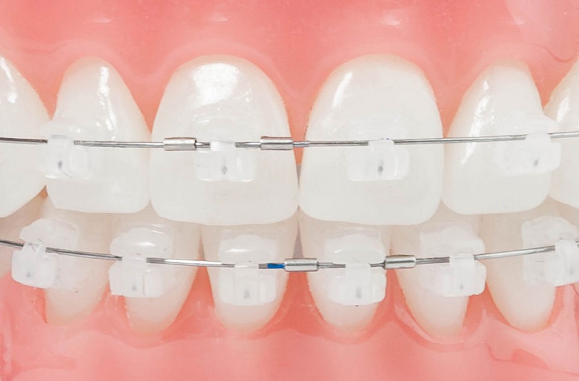 Niềng răng mắc cài sứ tự đóng