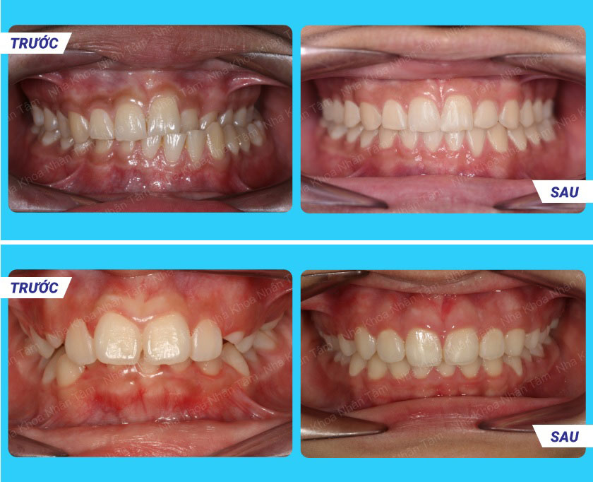 Khách hàng niềng răng thẩm mỹ thành công tại Nha khoa Nhân Tâm