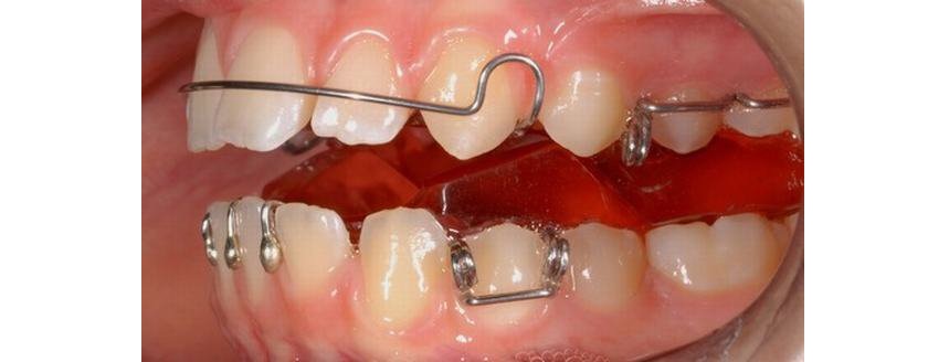 Những vấn đề xảy ra khi chỉnh nha cần đến nha khoa để được bác sĩ xử lý ngay lập tức