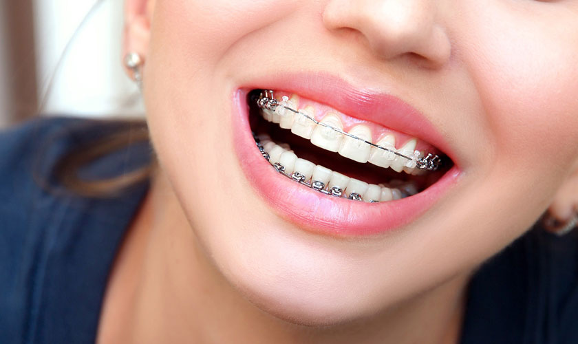 Niềng răng ở đâu tốt TPHCM? Tiêu chí lựa chọn địa chỉ uy tín