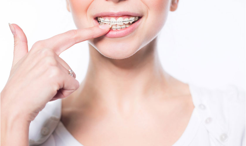 Chi phí niềng răng hô bao nhiêu tiền?