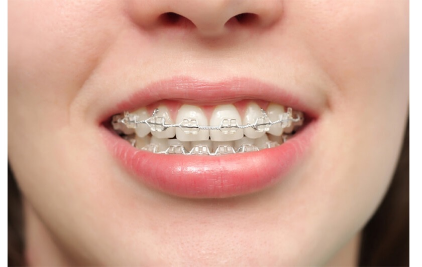 Niềng răng hô nhẹ