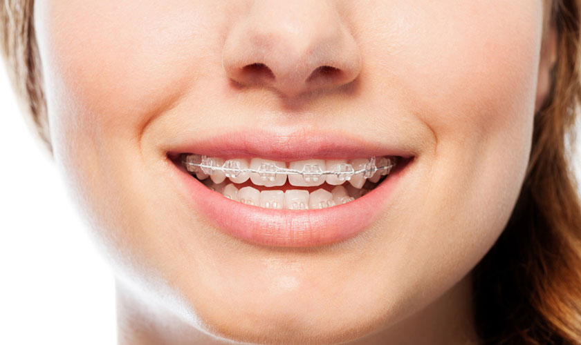 Niềng răng thưa mất bao lâu để đạt hiệu quả?