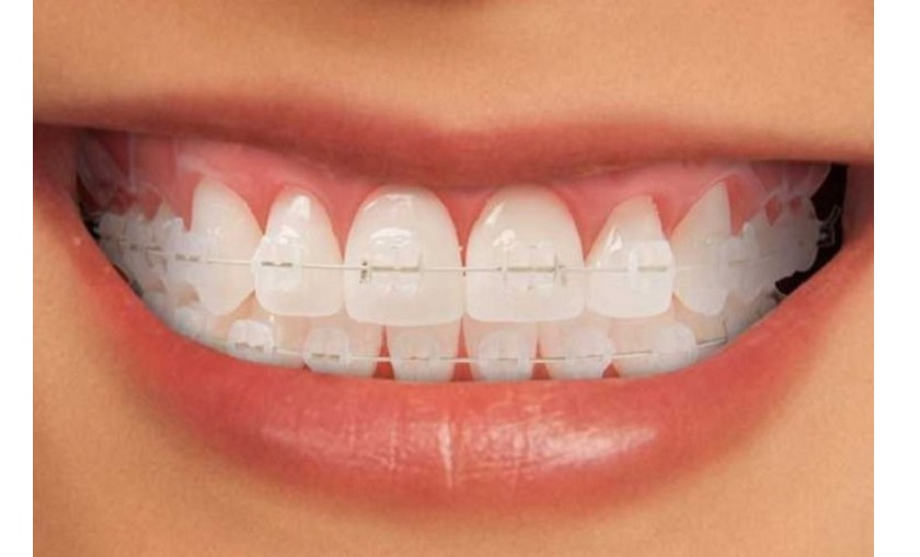 Niềng răng thưa với mắc cài sứ