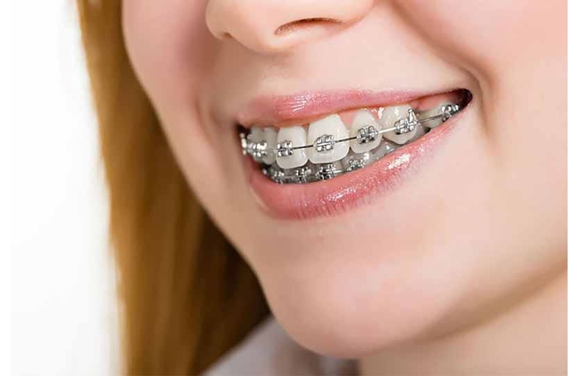 Niềng răng thưa mất bao lâu còn phụ thuộc vào nhiều yếu tố khác nhau