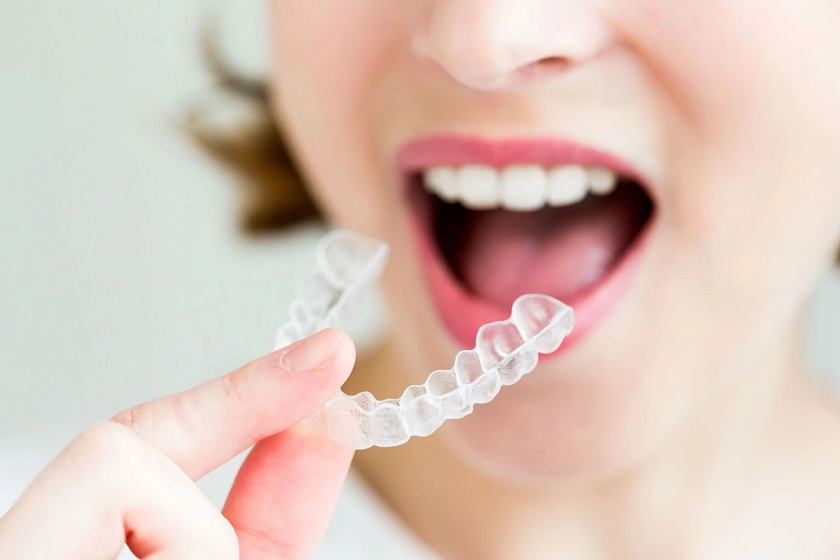 Khay niềng invisalign nên được đeo ít nhất 22h/ngày