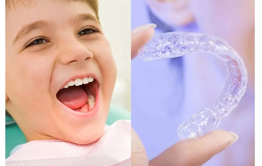 12 - 16 tuổi là thời điểm vàng để tiến hành chỉnh nha