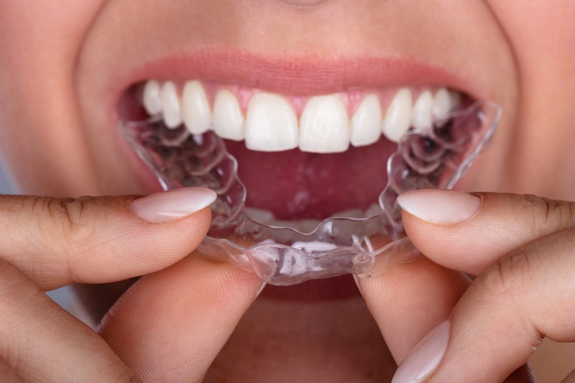 Niềng răng invisalign có nhiều ưu điểm vượt trội hơn phương pháp truyền thống