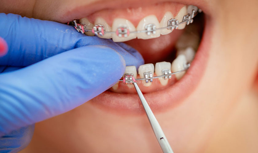 Bảng giá niềng răng trả góp