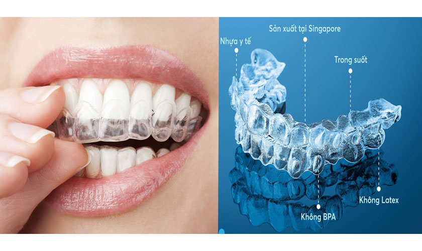 Niềng răng trong suốt giá bao nhiêu?