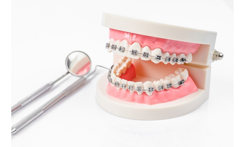 Niềng răng chỉnh nha là phương pháp được nhiều người lựa chọn