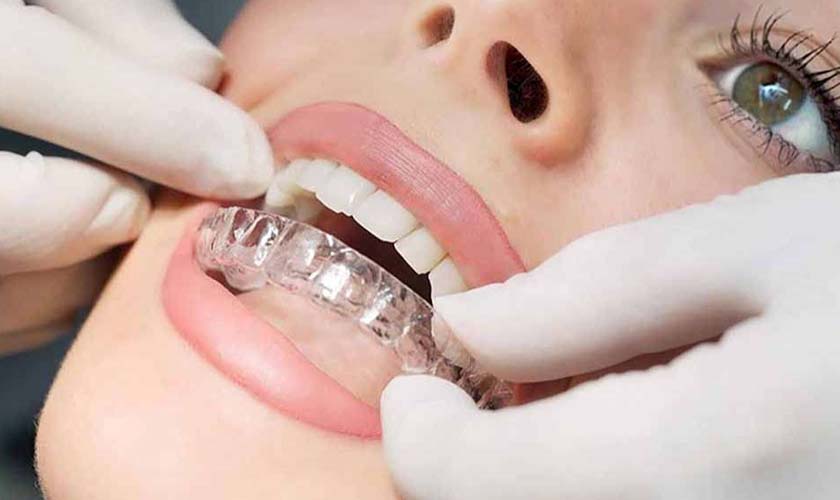 Niềng răng invisalign giá bao nhiêu? Câu hỏi liên quan