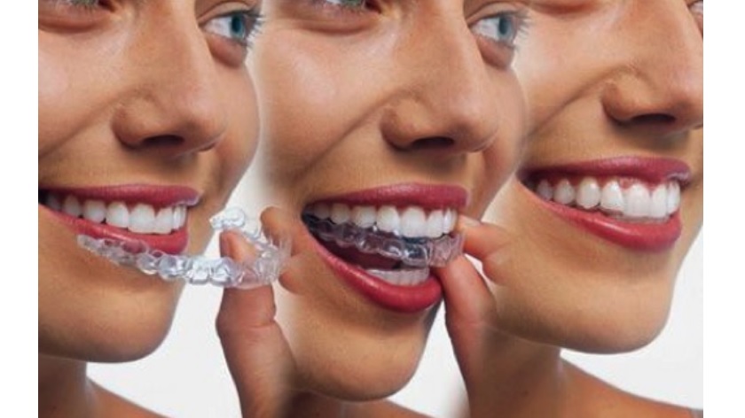 Niềng răng invisalign