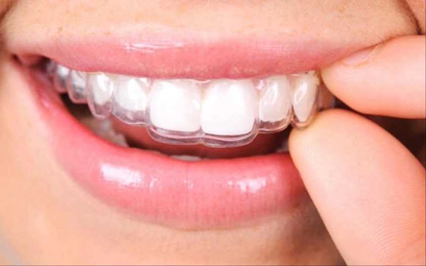 Niềng răng trong suốt Invisalign