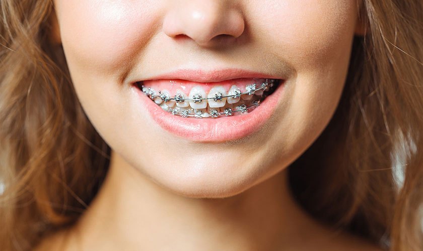 Các giai đoạn niềng răng diễn ra như thế nào?