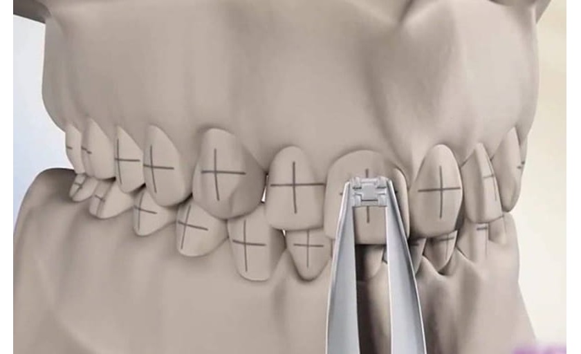 Gắn mắc cài là giai đoạn vô cùng quan trọng khi niềng răng