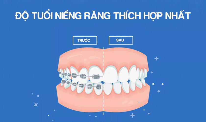 Độ tuổi niềng răng thích hợp nhất