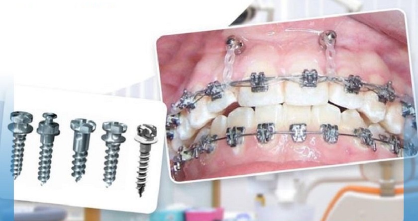 Bắt vít niềng răng có đau không?