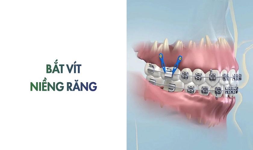 Bắt vít niềng răng có đau không?