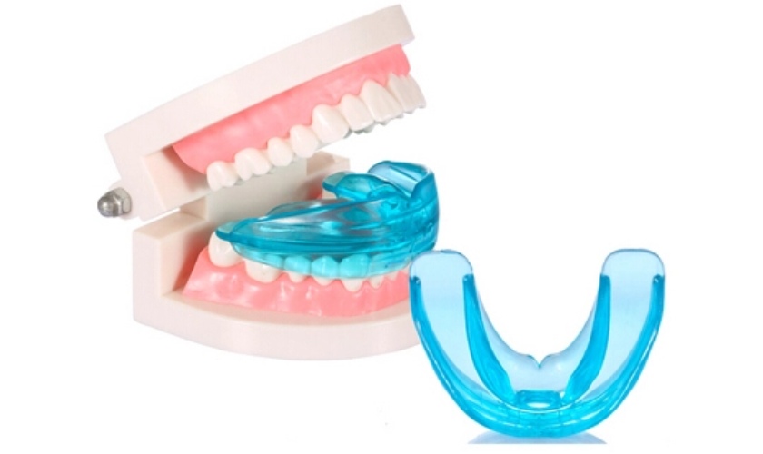 Bộ niềng răng tại nhà có tốt không là thắc mắc của nhiều người