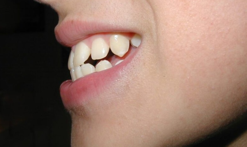 Những trường hợp hô nặng thì niềng răng tại nhà không mang lại hiệu quả