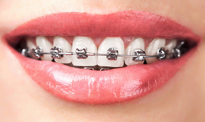 Niềng răng khấp khểnh với mắc cài kim loại Niềng răng khấp khểnh với mắc cài kim loại