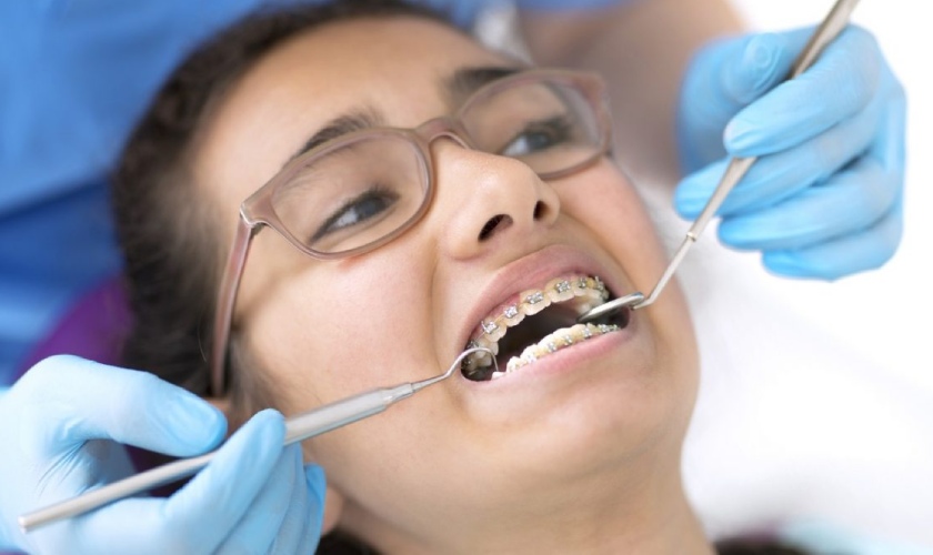 Các bước niềng răng diễn ra như thế nào?