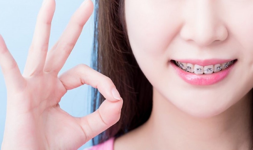 Niềng răng sẽ mang lại cho bạn nụ cười đẹp hoàn hảo