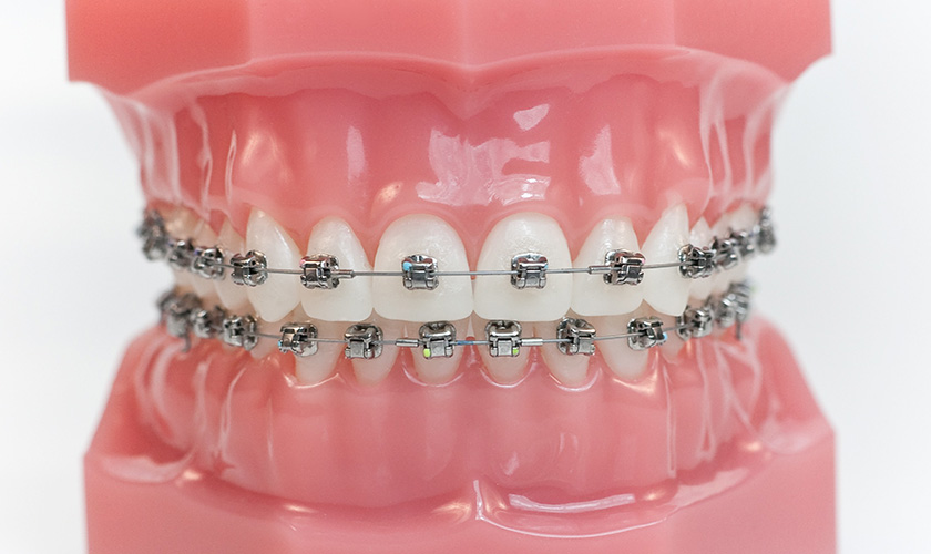 Các loại niềng răng