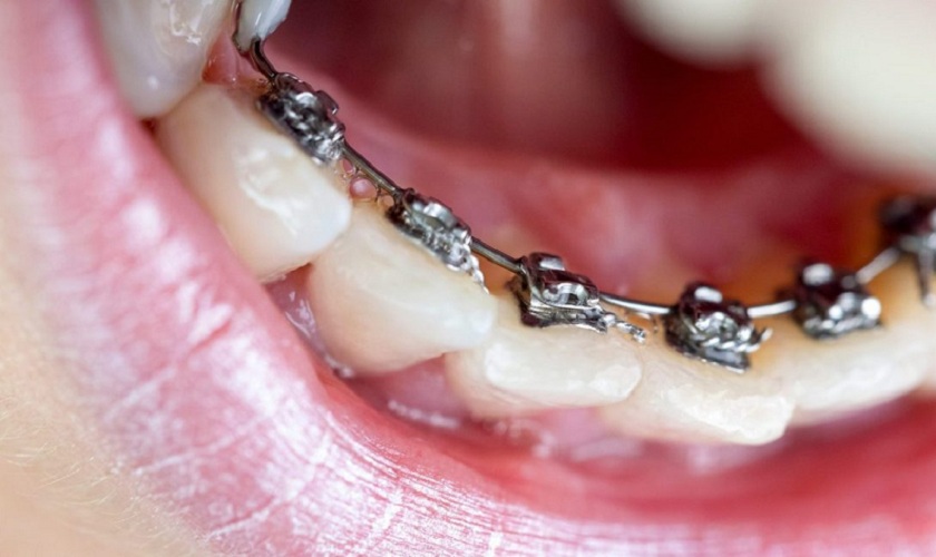 Các loại niềng răng