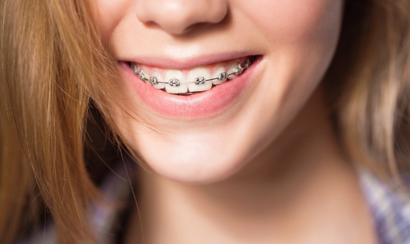 Niềng răng mang lại hiệu quả lâu dài