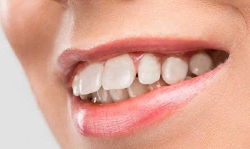 Các cách chữa răng hô tại nhà để cải thiện nụ cười của bạn