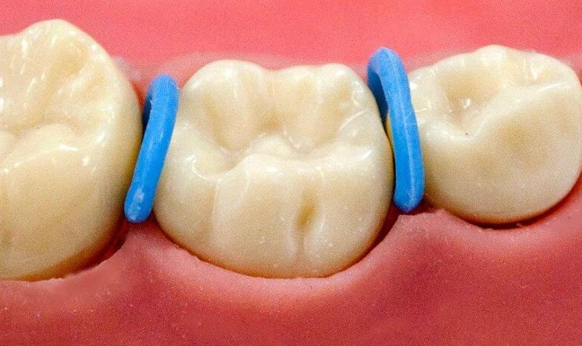 Thun tách kẽ có tác dụng nới rộng khoảng trống giữa các răng