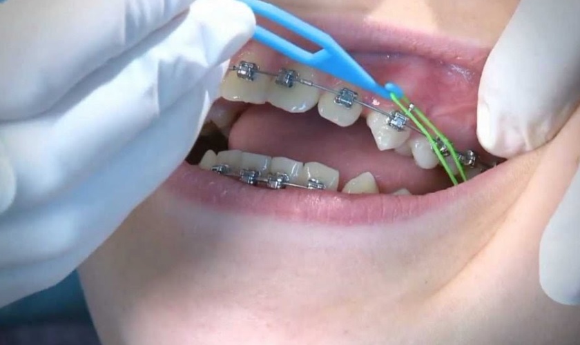 Thun liên hàm giúp các răng nhanh chóng trở về đúng vị trí trên cung hàm