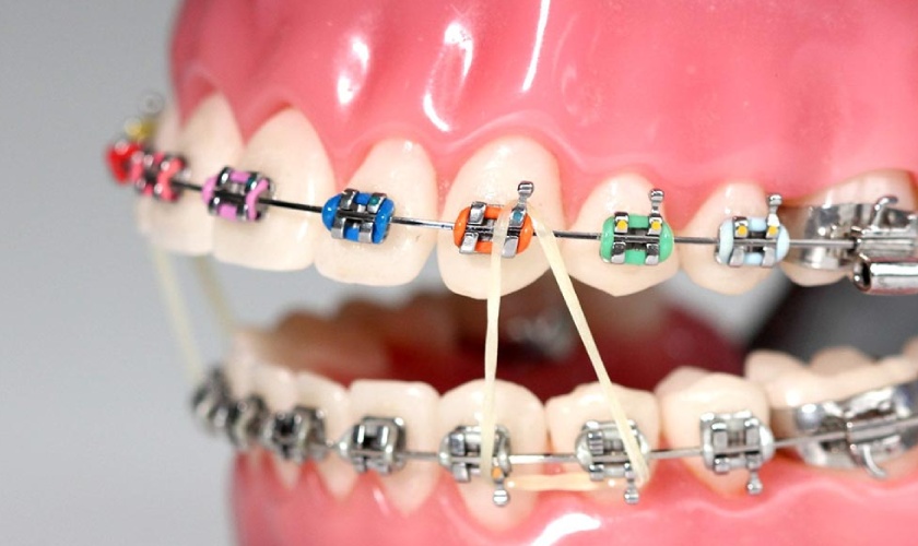 Cách phân biệt các loại dây thun niềng răng