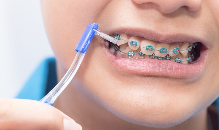 Bàn chải kẽ răng