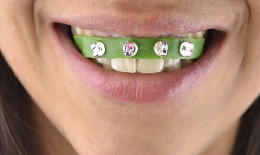 Cảnh báo nguy hiểm từ việc tự sử dụng đồ niềng răng tại nhà