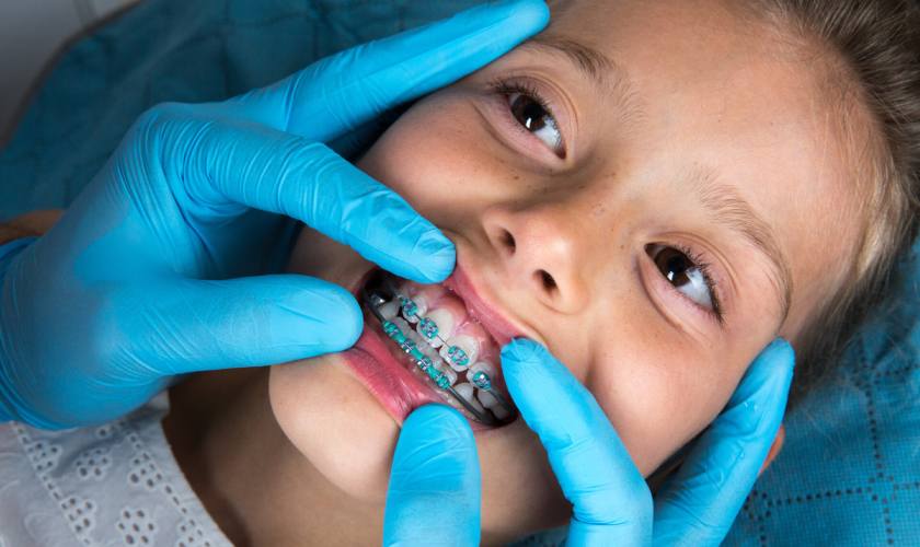 Cập nhật bảng giá niềng răng trẻ em mới nhất