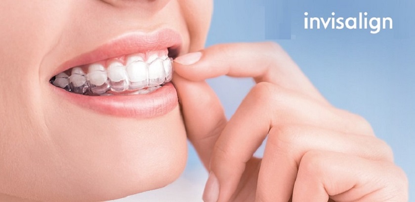 Chi phí niềng răng vô hình Invisalign