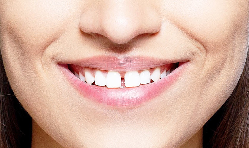 Răng cửa gặp nhiều khuyết điểm gây ảnh hưởng đến thẩm mỹ khuôn mặt