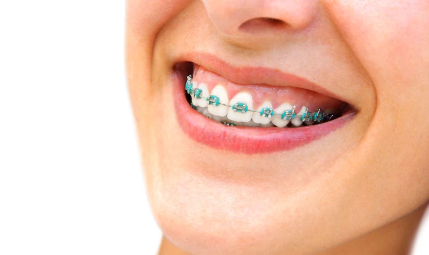 Chi phí niềng răng hô ở địa chỉ uy tín là bao nhiêu?