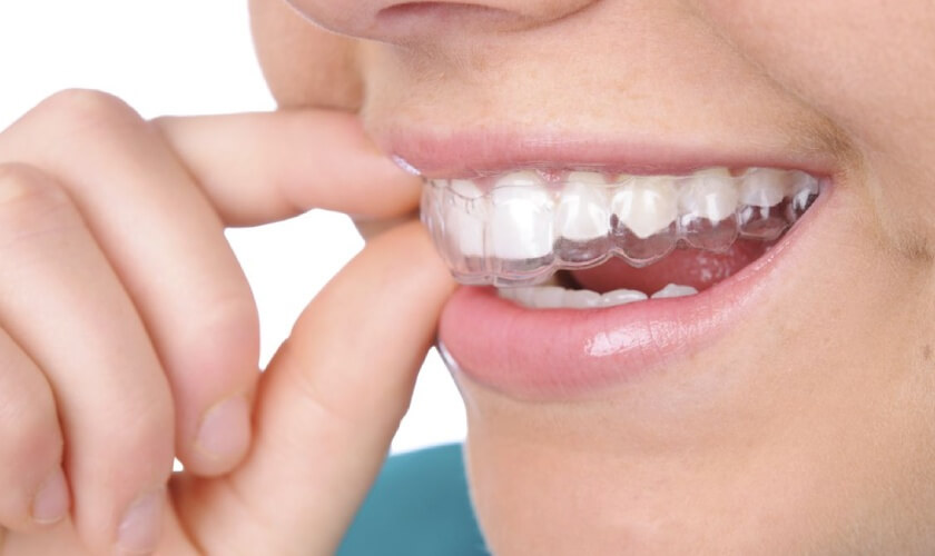 Niềng răng trong suốt mang lại thẩm mỹ cao trong suốt quá trình niềng