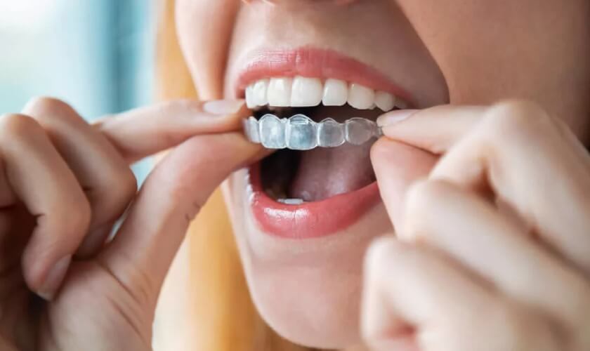 Chi phí niềng răng trong suốt hiện nay là bao nhiêu?	