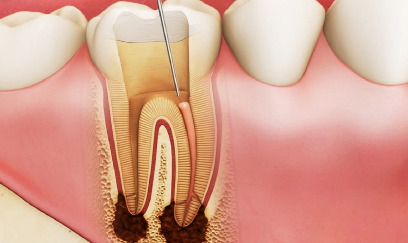 Niềng răng sai cách có thể gây mất tủy răng